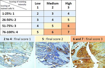 Detection of Glycosylated Markers From Cancer Stem Cells With ColoSTEM Dx Kit for Earlier Prediction of Colon Cancer Aggressiveness